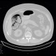 Pneumatosis intestinalis: CT - Computed tomography